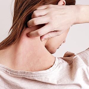 Exederm is the #1 recommended ingredient in a clean ultra hypoallergenic formulation