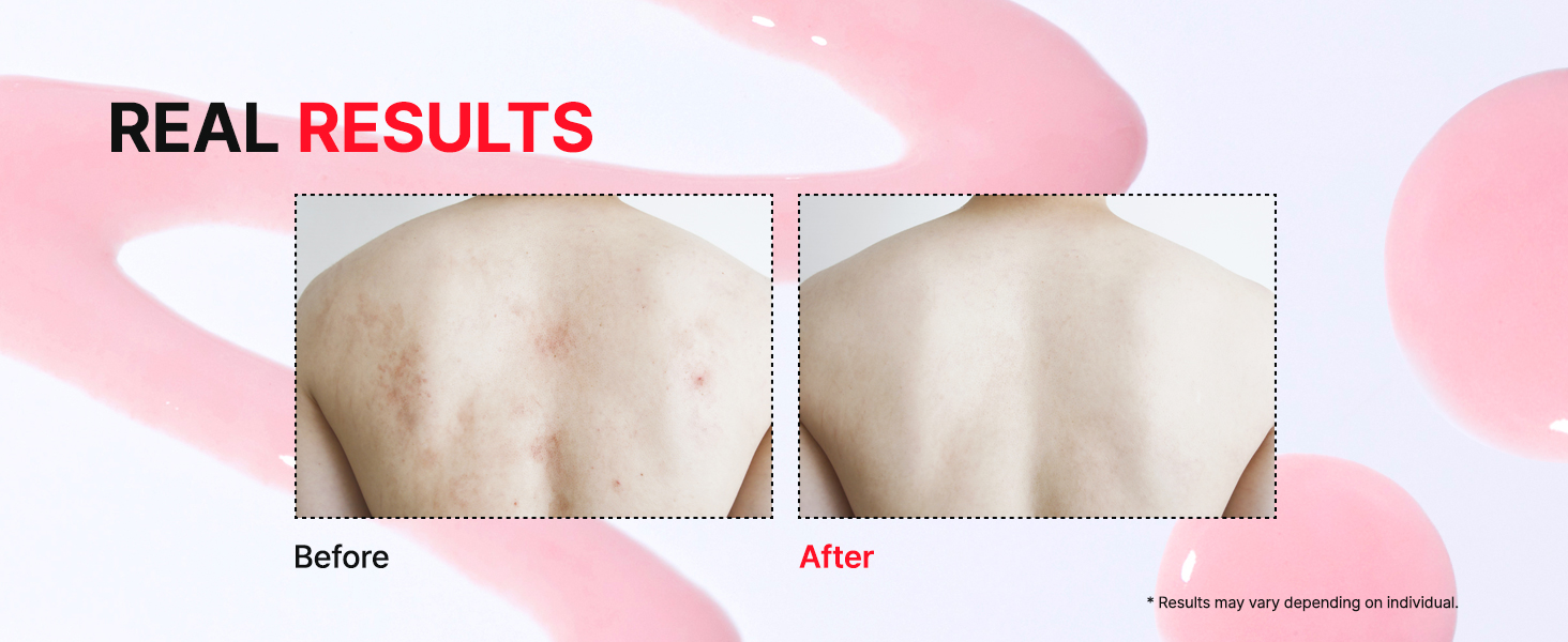Korean Skincare, Body Lotion, Bacne, Dull Skin, Acne-Prone Skin