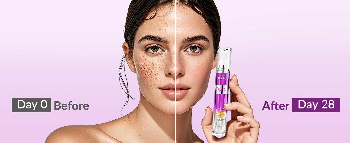 hydroquinone cream for dark spots