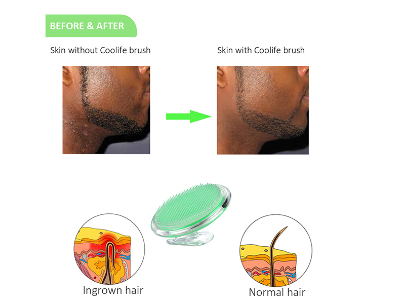 ingrown hair, keratolytic, keratosis pilaris exfoliator, treatment for keratosis pilaris