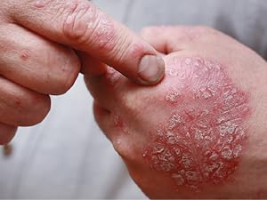 ezcema