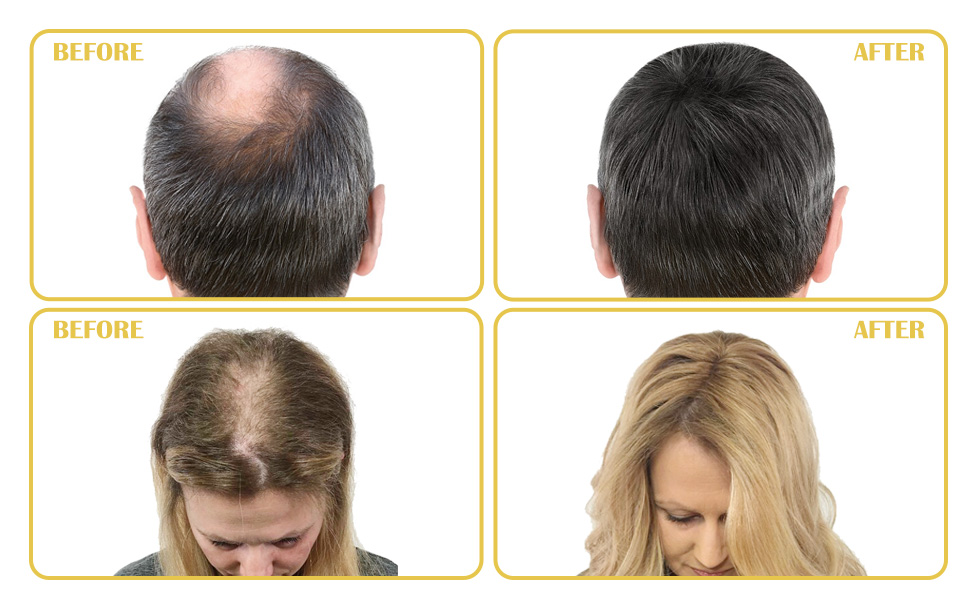 minoxidil serum