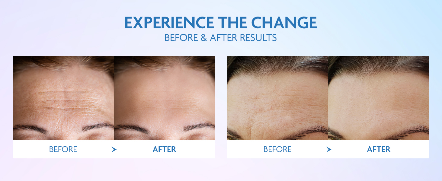 Dersie Silicone Forehead Wrinkle Patches 4