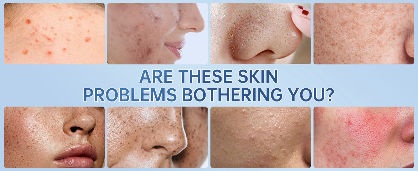 Azelaic Acid Cream for Acne