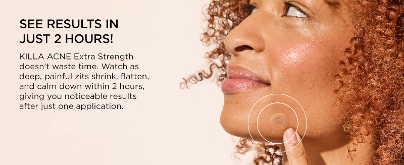 before and after effect of zitsticka extra strength microdart patches