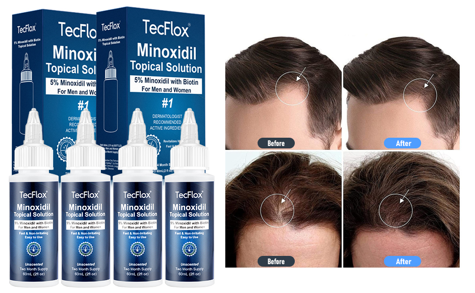 minoxidil for men