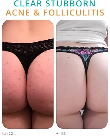Clear Folliculitis