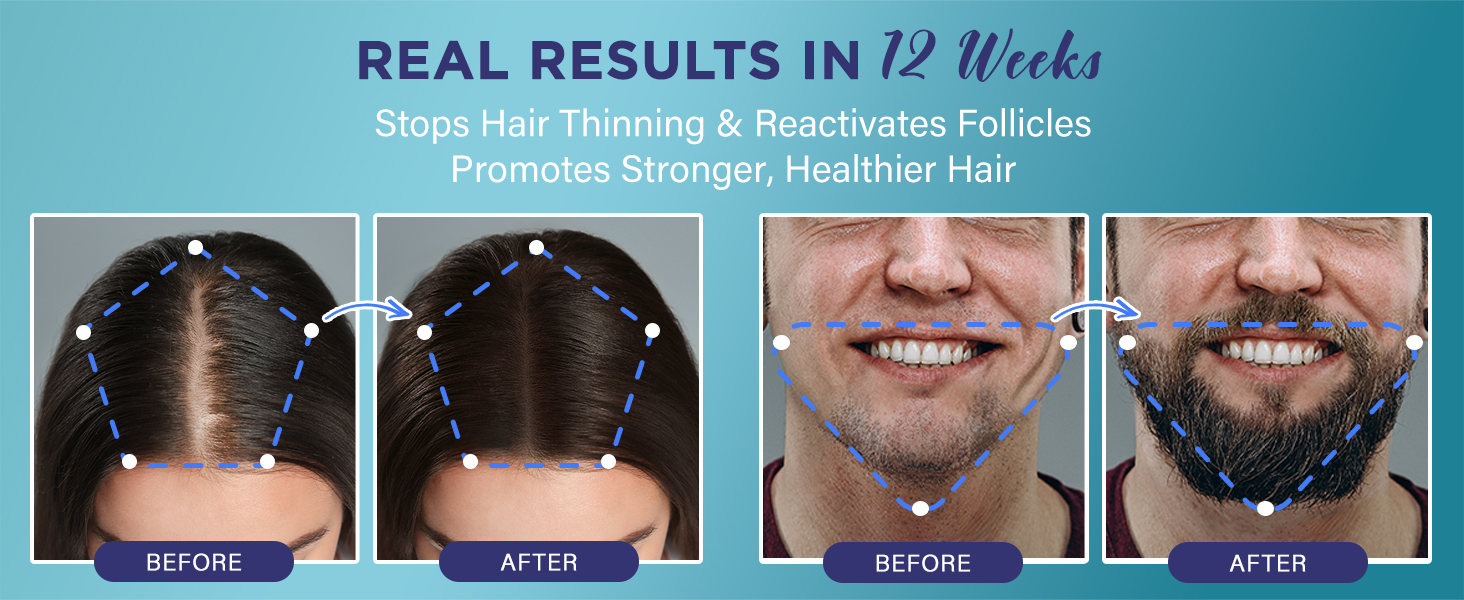 5% Minoxidil Spray Hair Regrowth Treatment Serum with Biotin & Rosemary