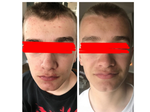 acne pills for teens