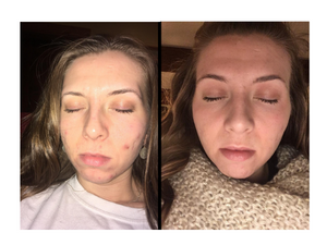 pills for acne women