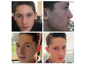 acne tablets for teens
