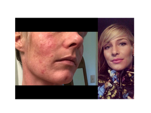 skin clear treatment