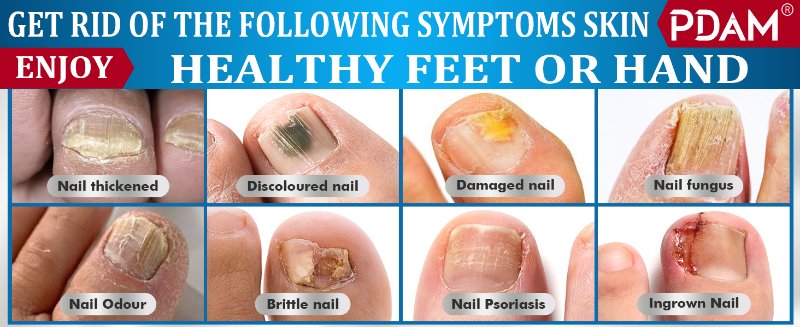 nail fungus treatment extra strength fungus nail treatment