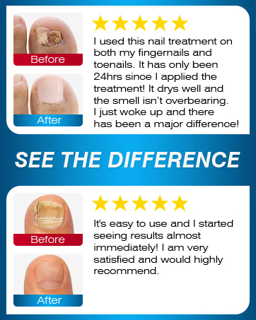 nail fungus treatment for toenail fungi nail nail fungus fungal nail treatment