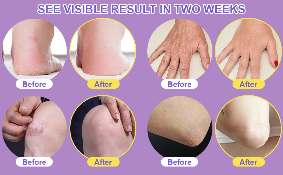 urea cream 40 percent for feet