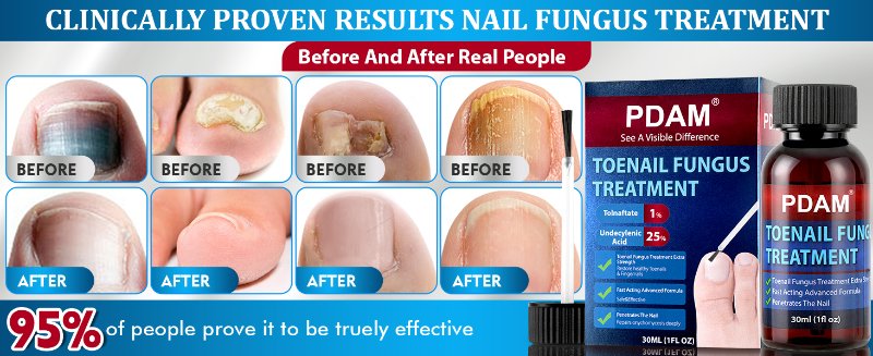 toenail fungus treatment toe fungus treatment for toenail nail fungus treatment for toenail