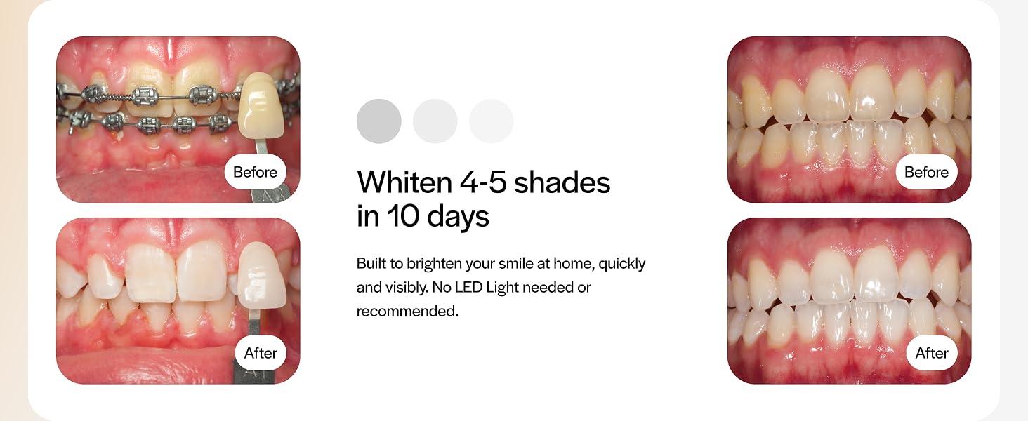 GOTD5 Go Trays Teeth Whitening Opalescence