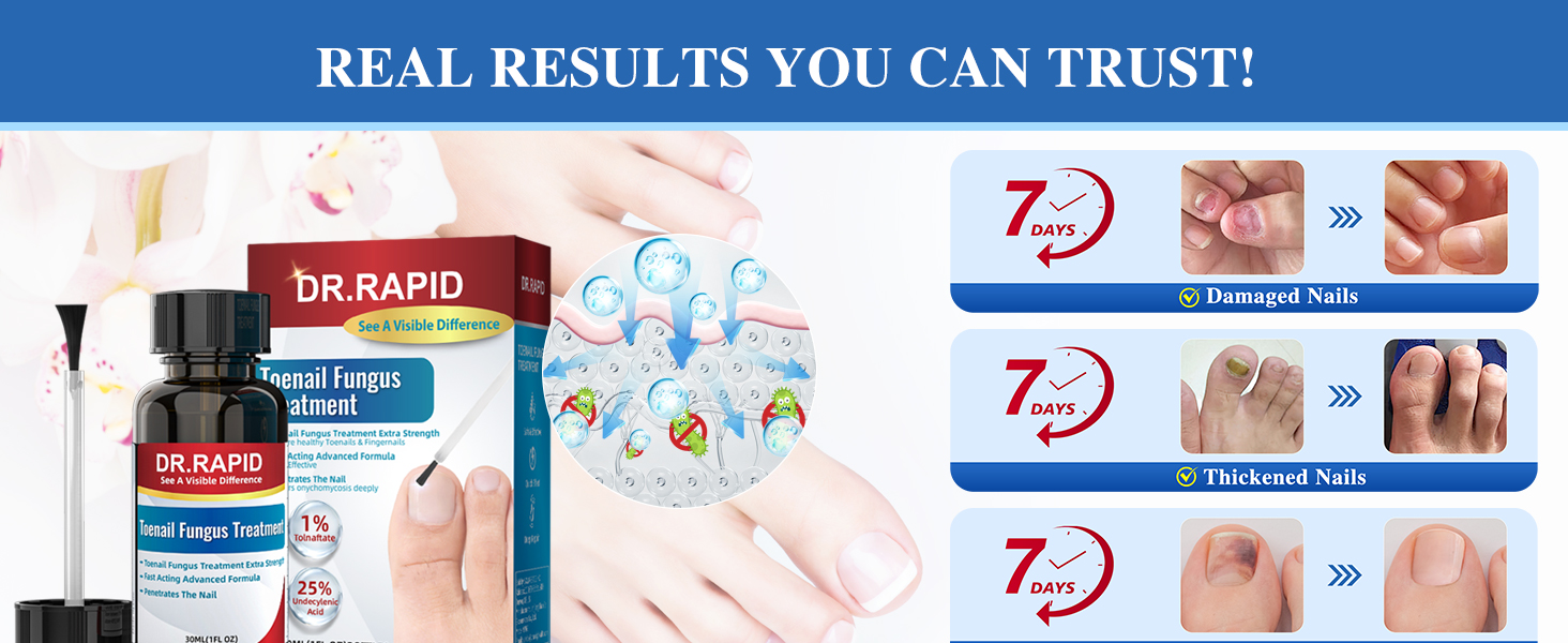 toenail fungus treatment extra strength nail fungus treatment extra strength