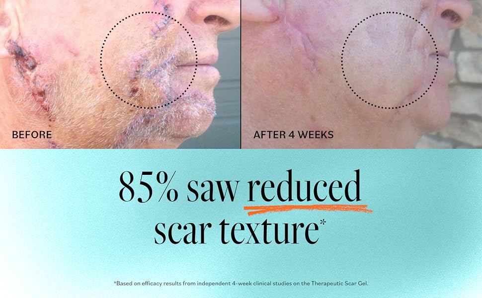 Scar Gel before and after 