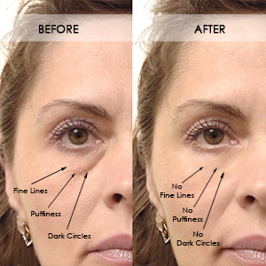 puffy_eye_Puffy Eye Treatment Before Aftertreatment