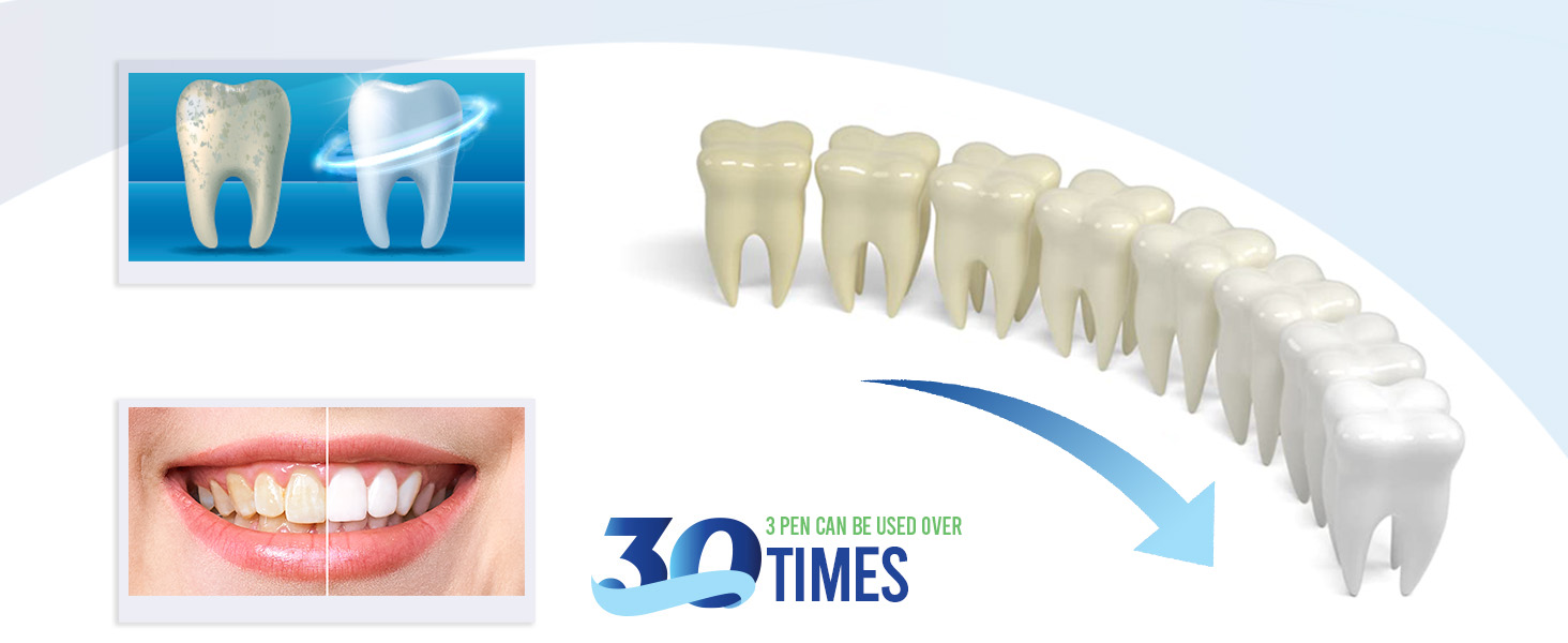 Teeth Whitening