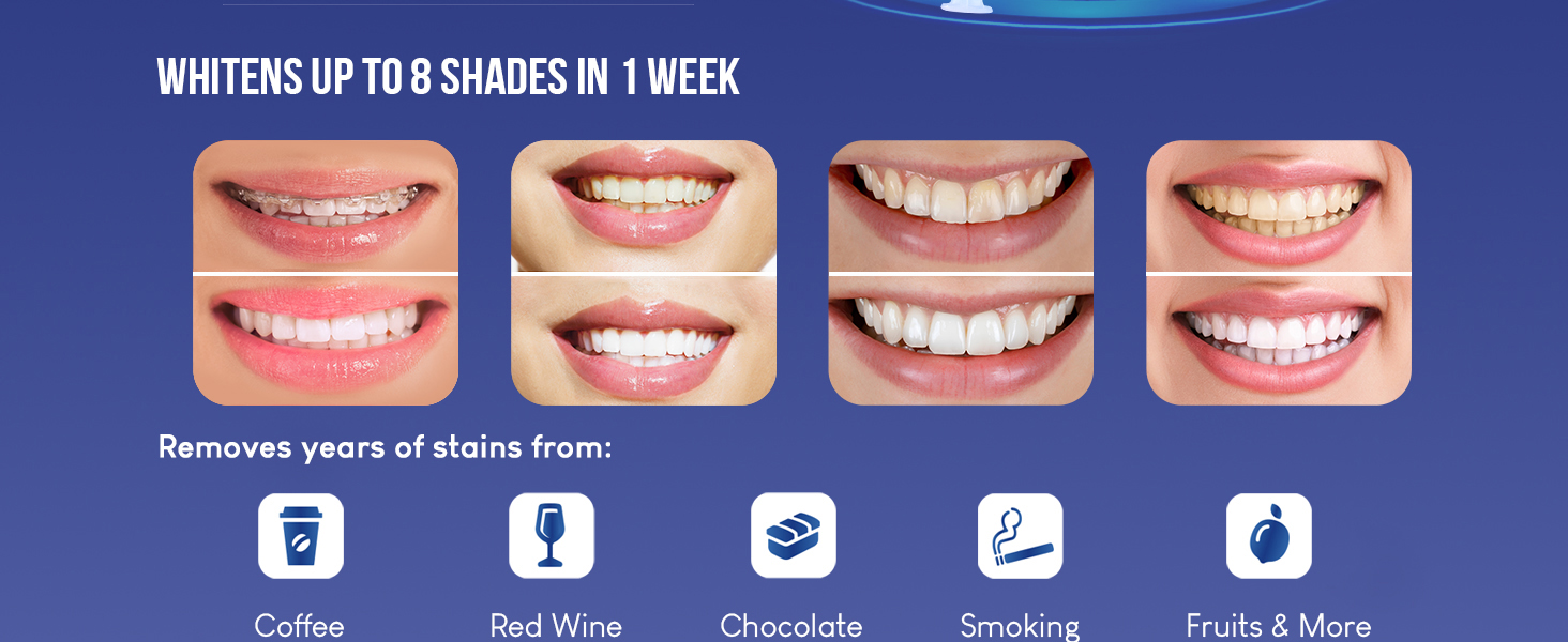 Teeth Whitening Kit