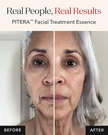 Real People Real Results PITERA facial treatment essence before and after image