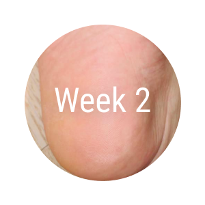 Exfoliation Foot  Peel for Men