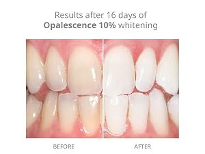 10% Syringes Opalescence