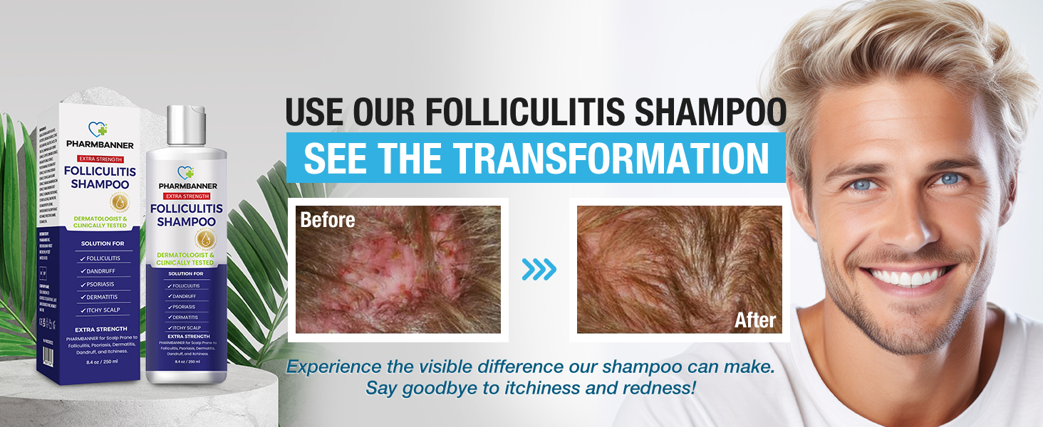 Psoriasis treatment