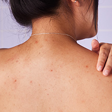 Probiotics are proven to reduce breakouts 