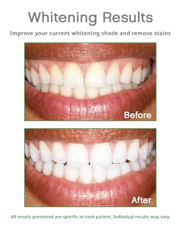 Teeth Before and After Opalescence 