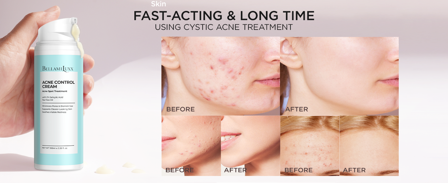 acne spot treatment