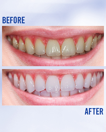 Teeth Whitening