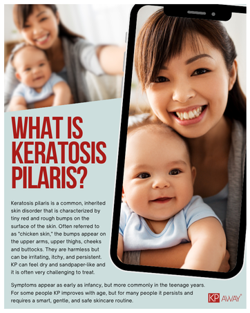 What is KP Keratosis Pilaris