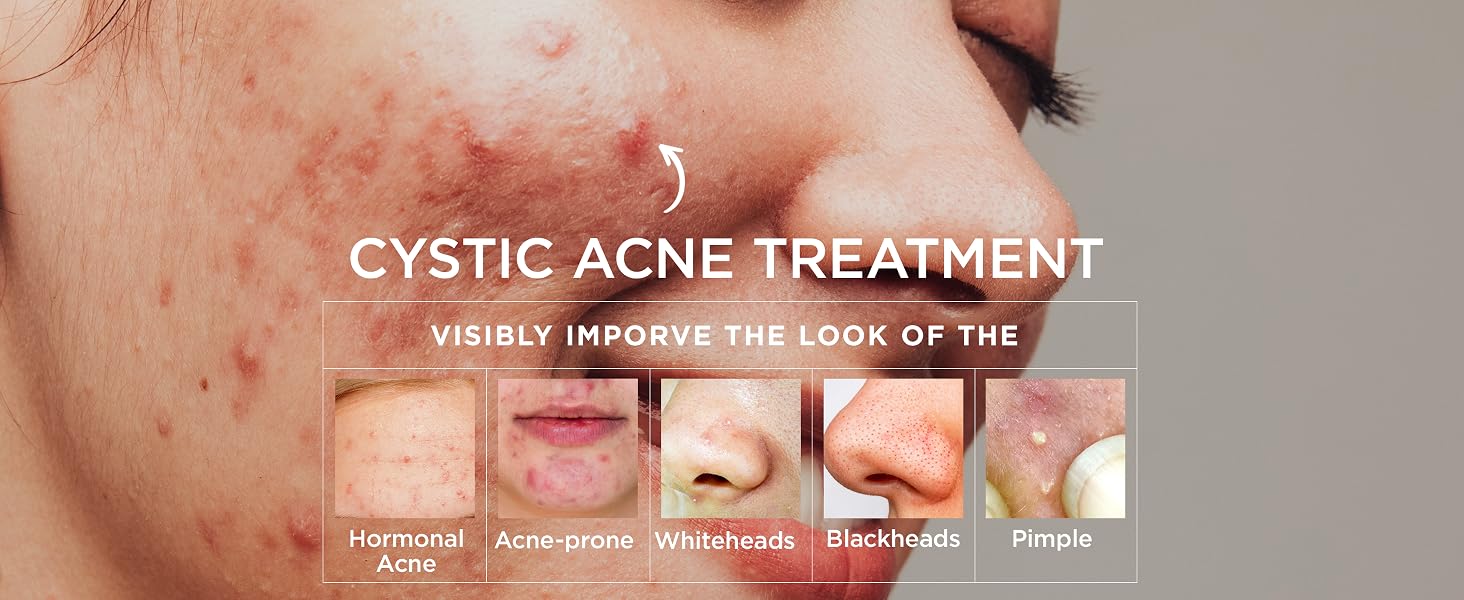 acne treatment for face