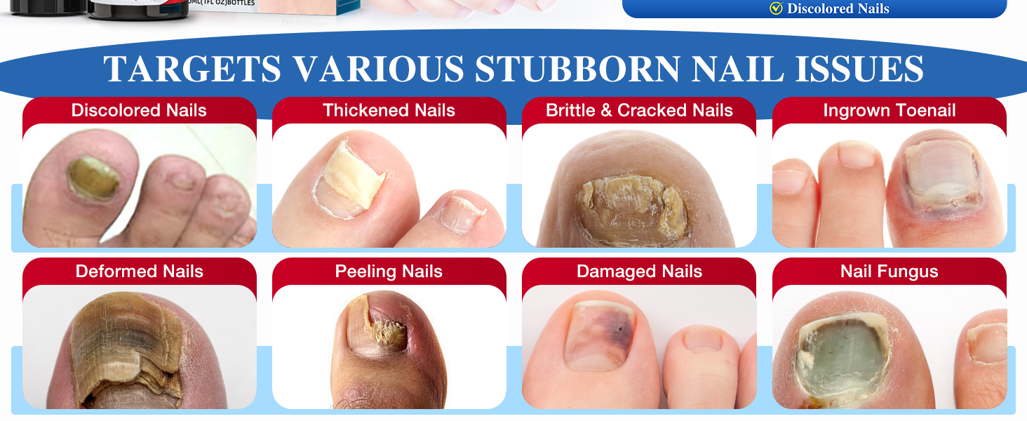 toenail fungus treatment extra strength nail fungus treatment extra strength