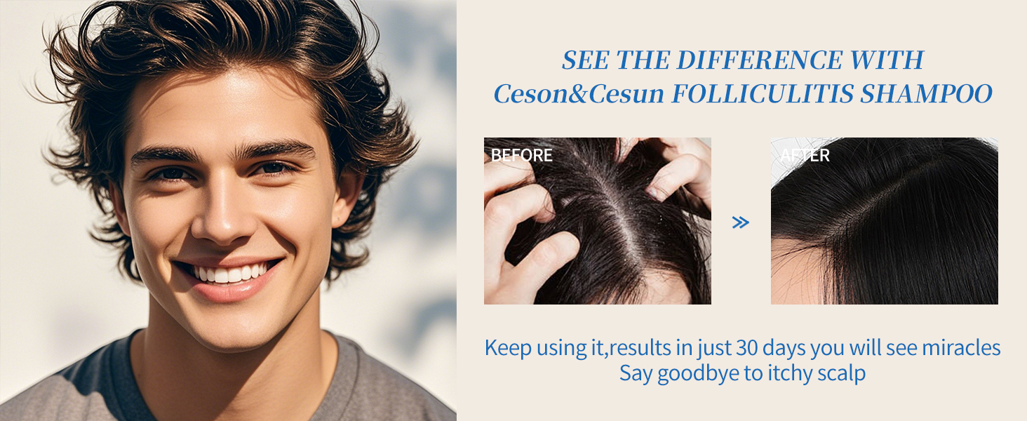 Folliculitis, Seborrheic Dermatitis Shampoo