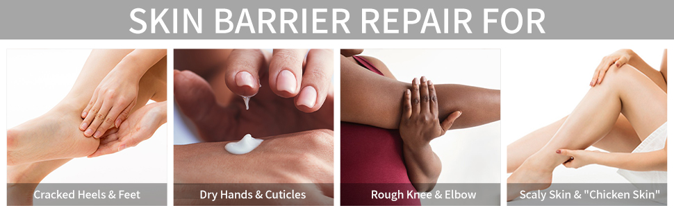 Cracked Heels & Feet Dry Hands & Cuticles Rough Knee & Elbow Scaly Skin & 