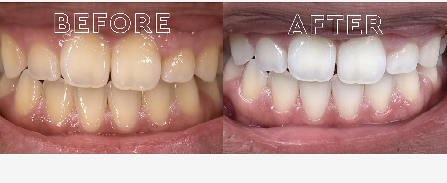 teeth whitening strips 7 shades lighter in 2 weeks