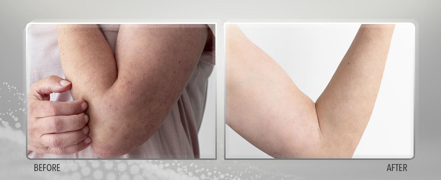 Sulfur Balsam, psoriasis