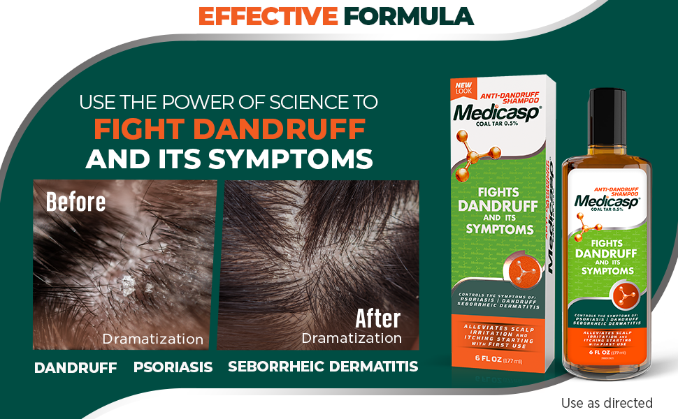 Effective formula – dandruff shampoo for men & women with psoriasis & seborrheic dermatitis