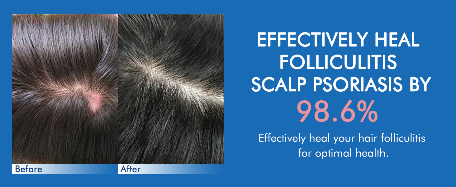 Ceson&amp;amp;Cesun Folliculitis, Seborrheic Dermatitis Shampoo