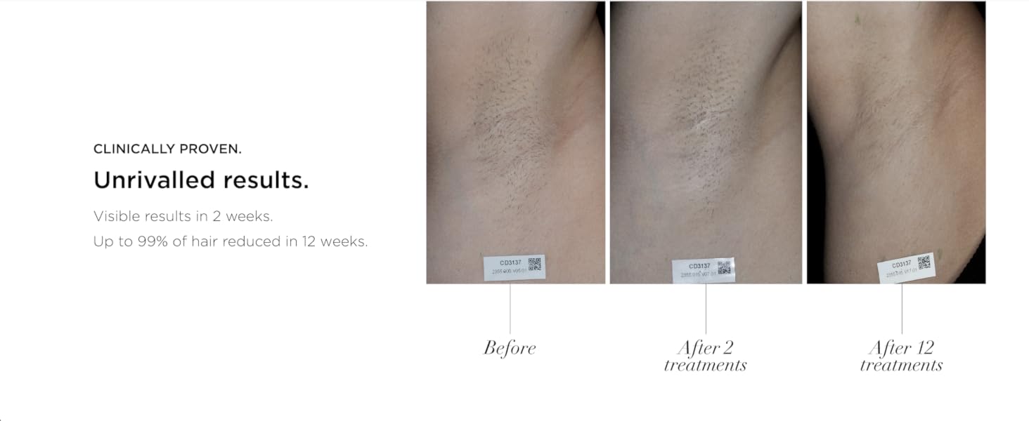 CLINICALLY PROVEN. Unrivalled results in 2 weeks. Up to 99% of hair reduced in 12 Weeks