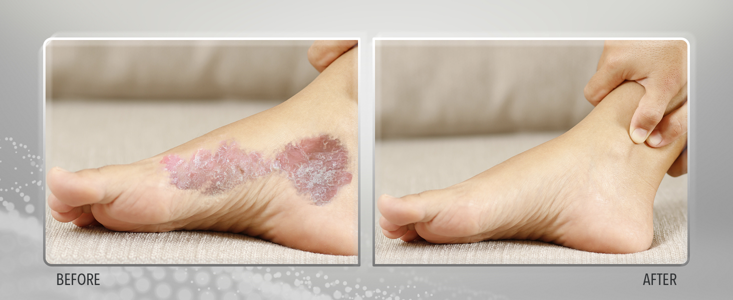 Sulfur Balsam, psoriasis