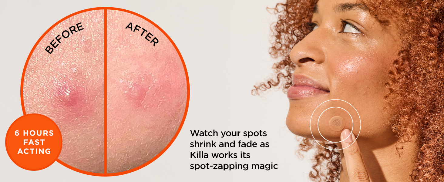 face pimple patches before and after six hours