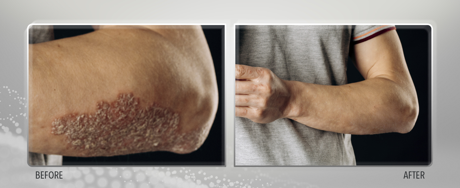 Sulfur Balsam, psoriasis