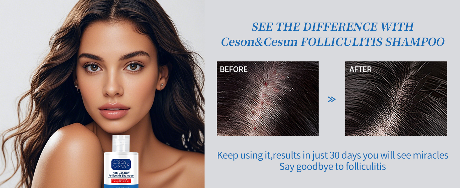 Folliculitis, Seborrheic Dermatitis Shampoo