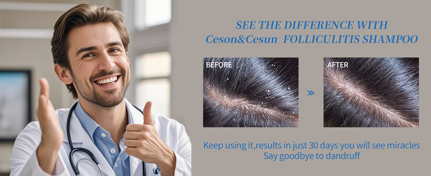 Folliculitis, Seborrheic Dermatitis Shampoo