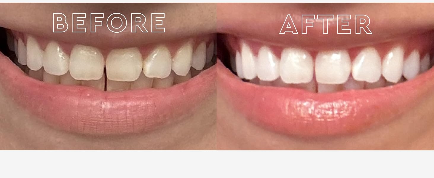 teeth whitening strips